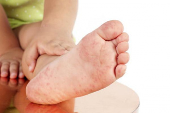 Đẩy nhanh tiêm chủng vaccine phòng, chống bệnh sởi