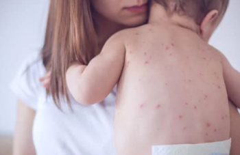 Hướng dẫn chẩn đoán và điều trị bệnh sởi